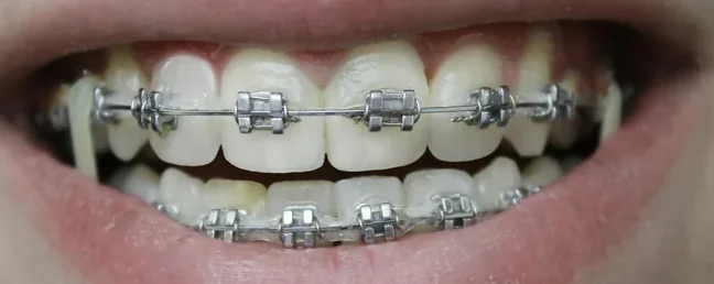 Rögzített fogszabályozó fém brackettekkel és dróttal, közelről